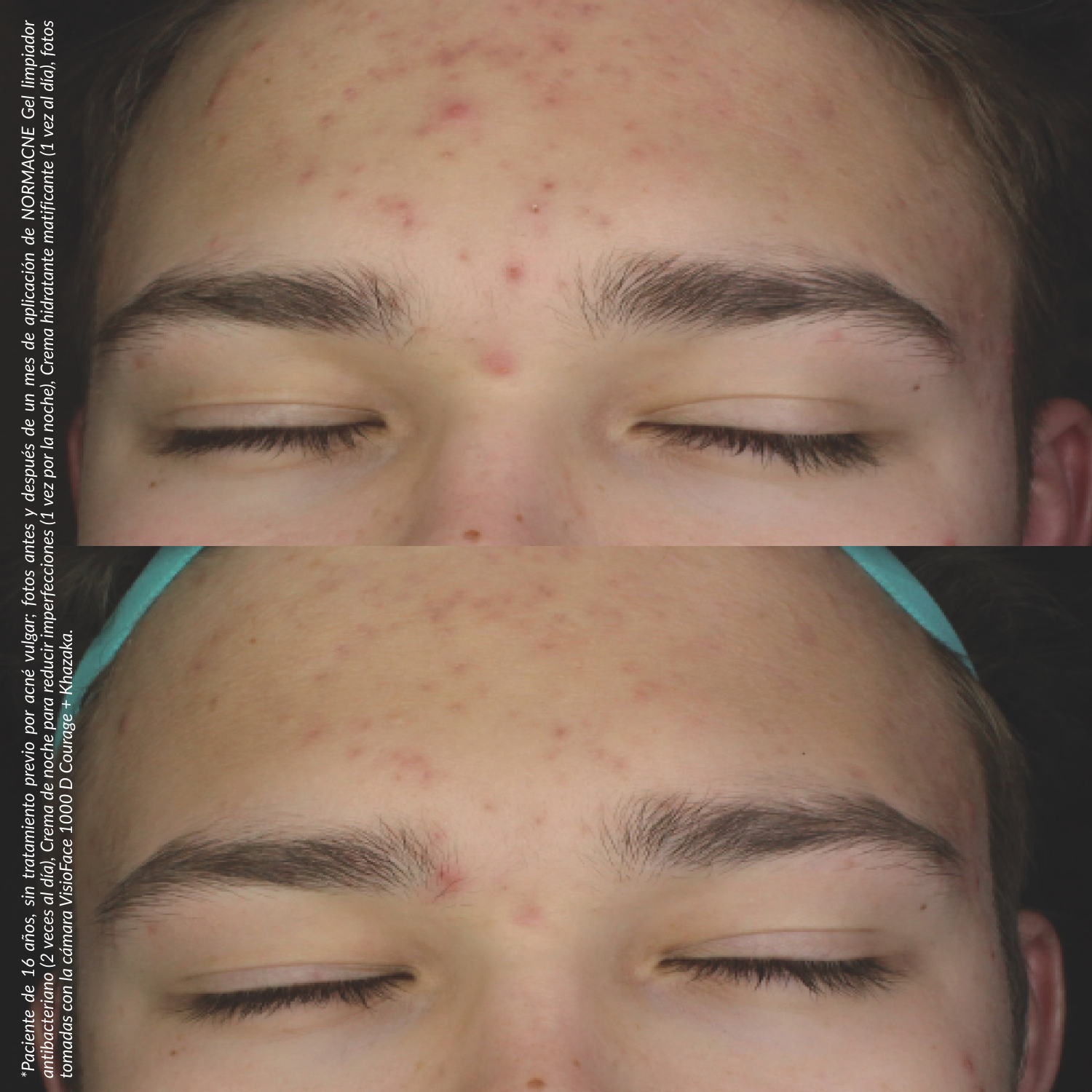 Tónico limpiador y seboregulador - NORMACNE | Dermedic - Imagen 2