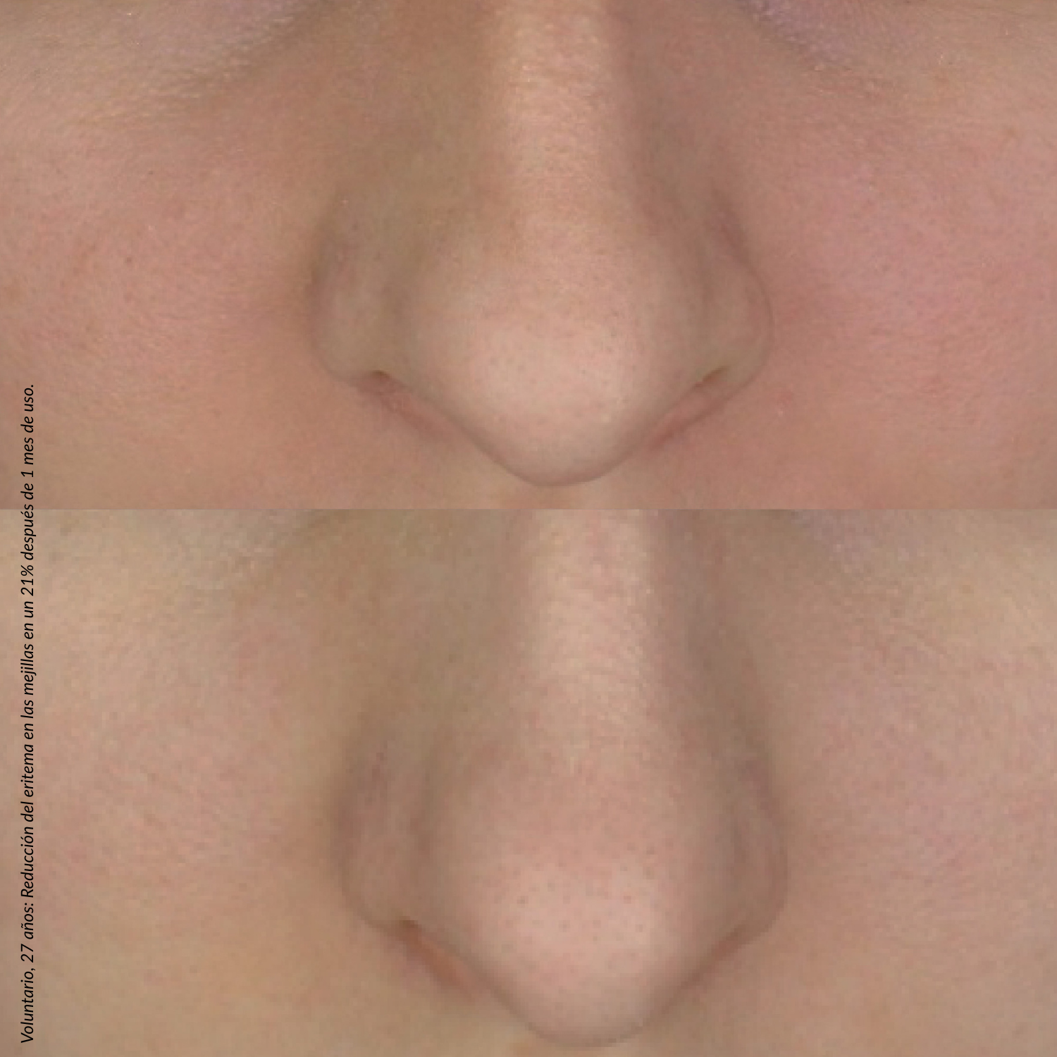 Crema Concentrada anti-rojeces - REDNESS | Dermedic - Imagen 4