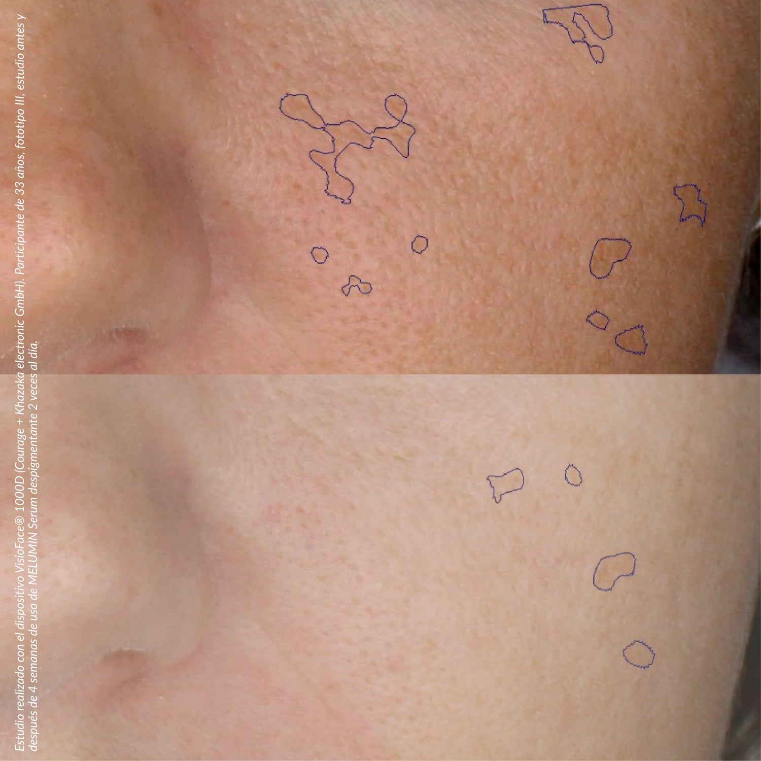 Sérum Despigmentante - MELUMIN | Dermedic - Imagen 2